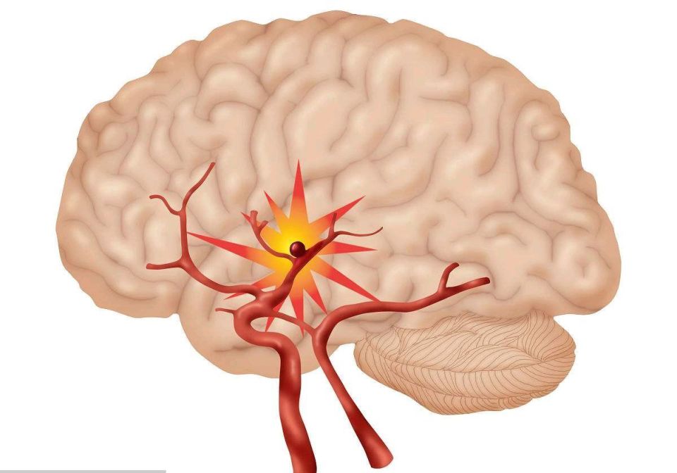 防治卒中，这些知识了解一下