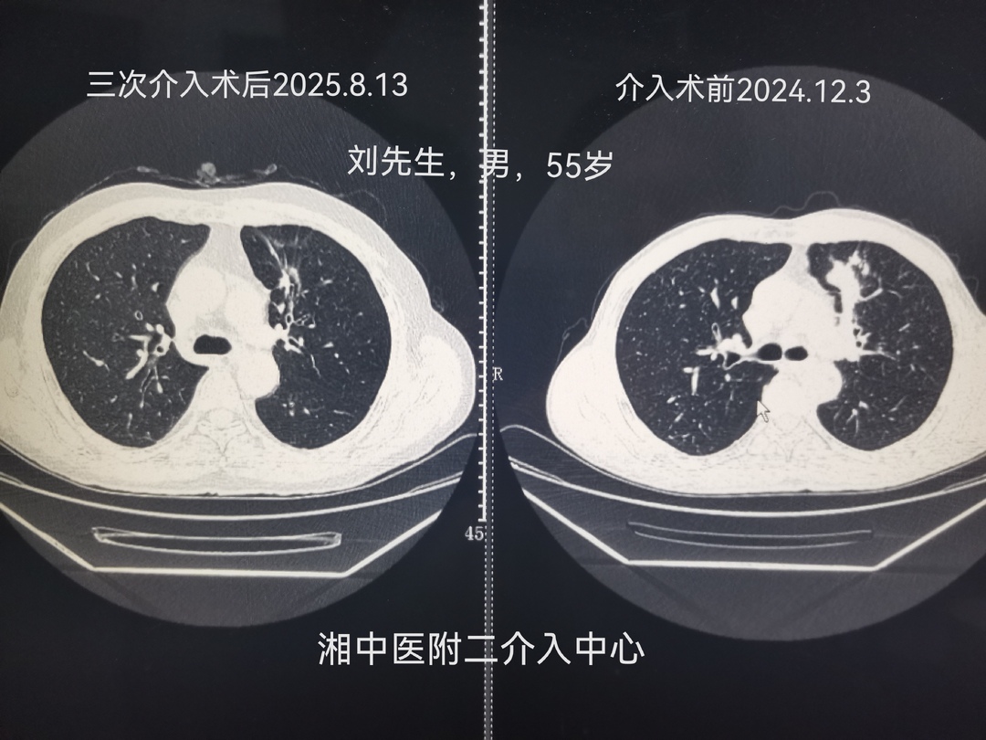 湖南率先开设细胞和基因治疗门诊，精准医疗迈入新纪元
