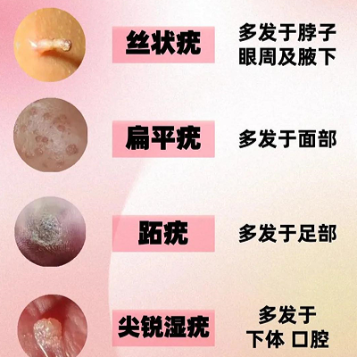 二价HPV疫苗纳入国家免疫规划 皮肤上这些小疙瘩 跟HPV感染有关