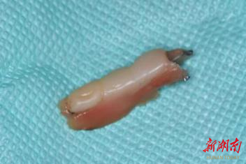 老人贪图便宜佩劣质假牙 两年后诱发口腔癌！