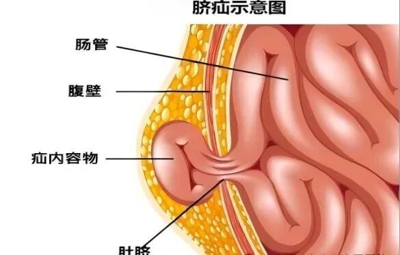 8年脐疝反复突出 腹腔镜微创技术TES解难题