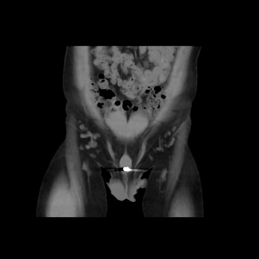 警惕青春期“好奇心”：12岁男孩尿道藏“金币” 2个月引发血尿