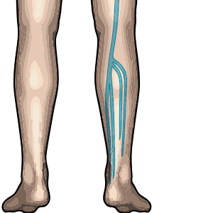 腿上爬“蚯蚓”？不止难看，还可能“烂腿”，甚至引发生命危险！