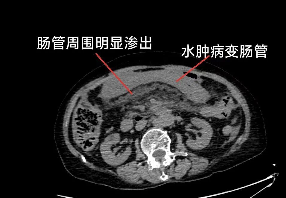 从剧痛到休克，这个疾病可致命！