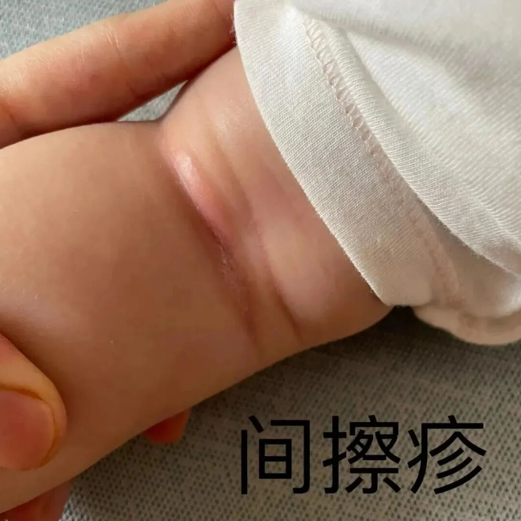  肥胖不止伤内脏，皮肤发出的“求救信号”你读懂了吗？