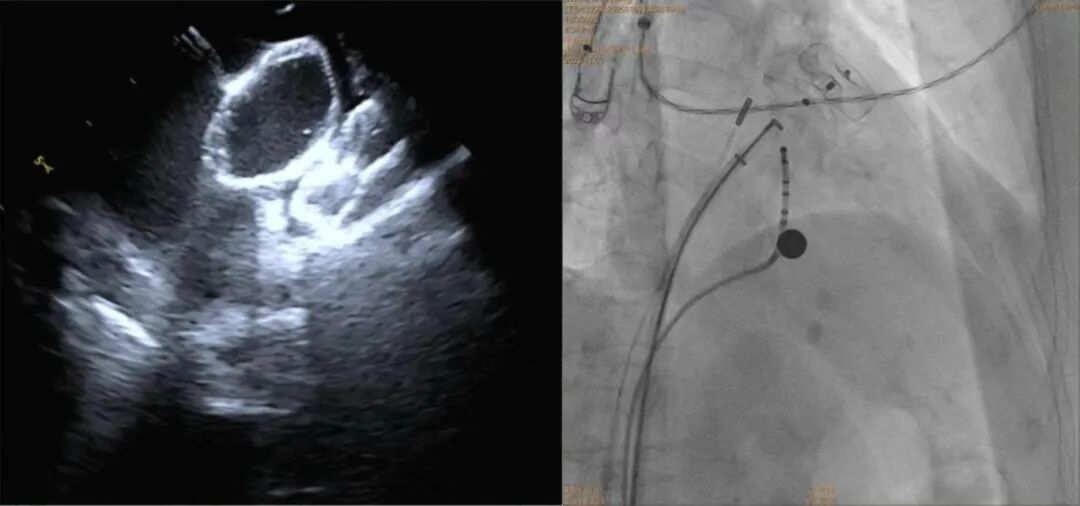 房颤之隐，卒中之危：一站式手术守护心脑健康