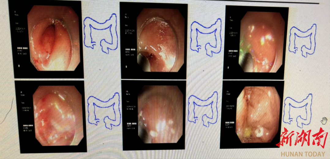8岁娃突发阑尾炎，开刀还是保守？长沙市第三医院ERAT技术实现“无疤治愈”