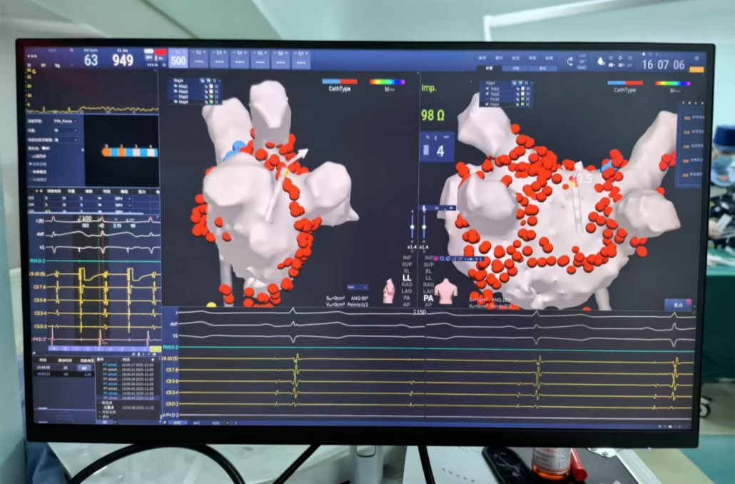 房颤之隐，卒中之危：一站式手术守护心脑健康