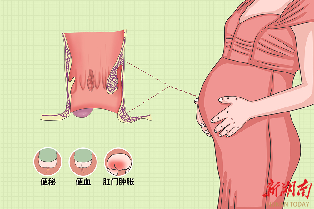 痔疮为何爱“盯”孕妈妈？