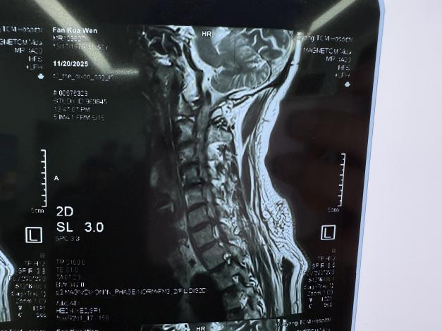 “钥匙孔”微创术解决颈椎病