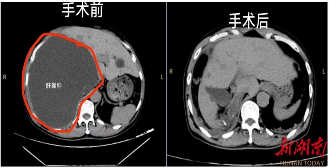 医疗服务提升年∣东安县人民医院肝胆外科成功实施巨大肝囊肿微创手术