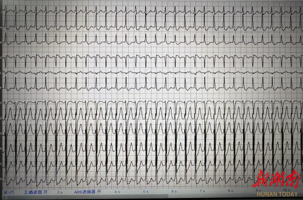 连续熬夜，男子心跳“狂飙”180/分 急诊医生：学会这个动作可“自救”