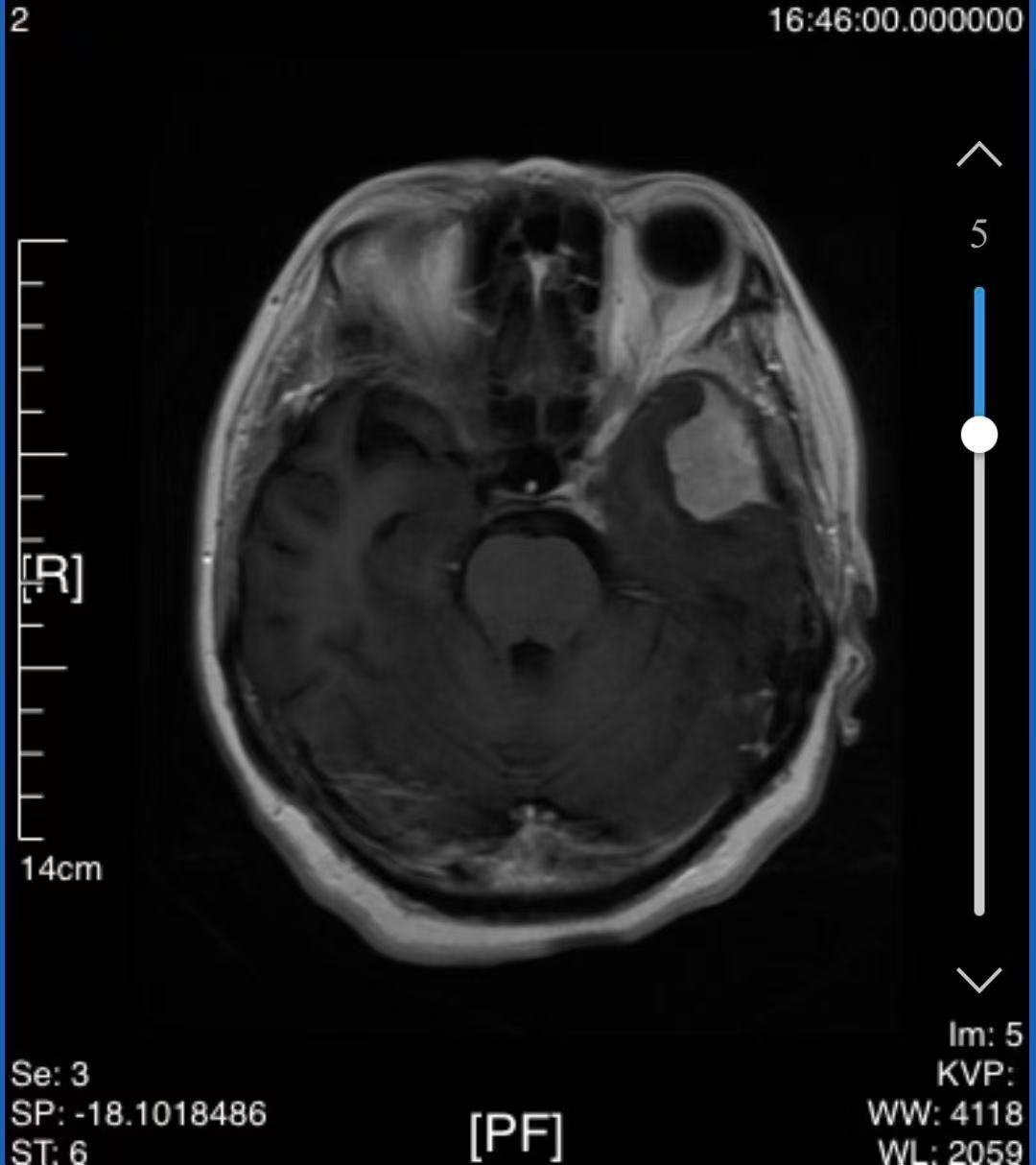 3500公里生命接力：医院专家赴新疆完成高难度脑瘤手术