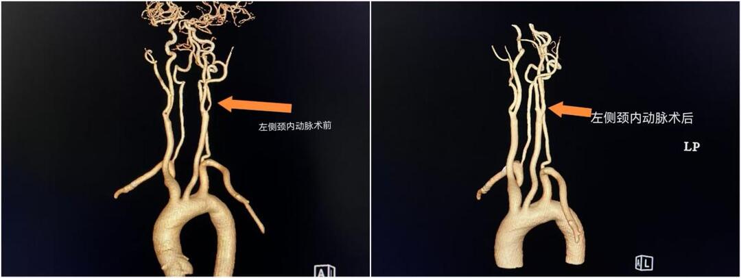 从肢体无力到行走自如 娄底市中心医院破解颈动脉90%堵塞救治难题