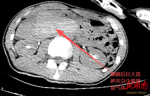 医疗服务提升年｜永州市中心医院：车祸重伤生命垂危  深夜奋战挽救年轻生命