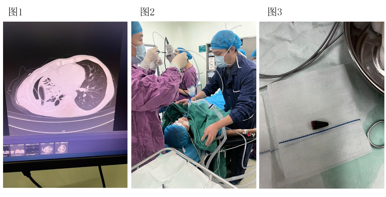 反复咳嗽五年查不出因？原是笔套藏气道十余年！