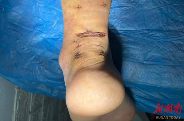 第45天下地、第77天日行万步！益阳医专附属医院微创术为跟腱患者按下康复“快进键”