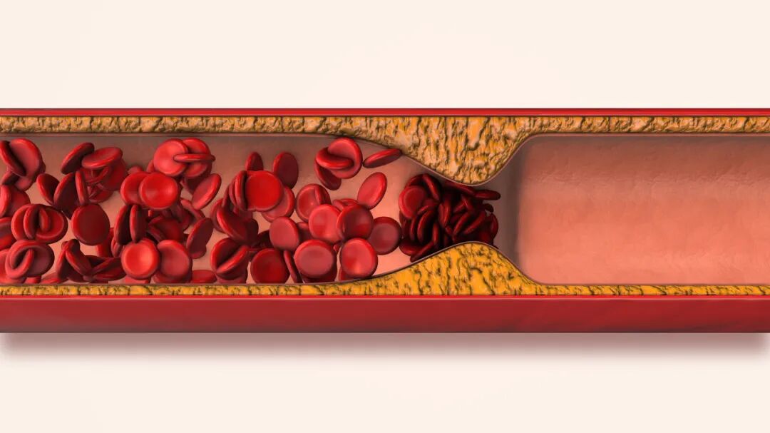 你的血管正在悄悄长斑变硬！这样做，“斑块”可能缩小甚至消失……