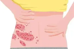 50岁以上高发 带状疱疹如何科学预防？