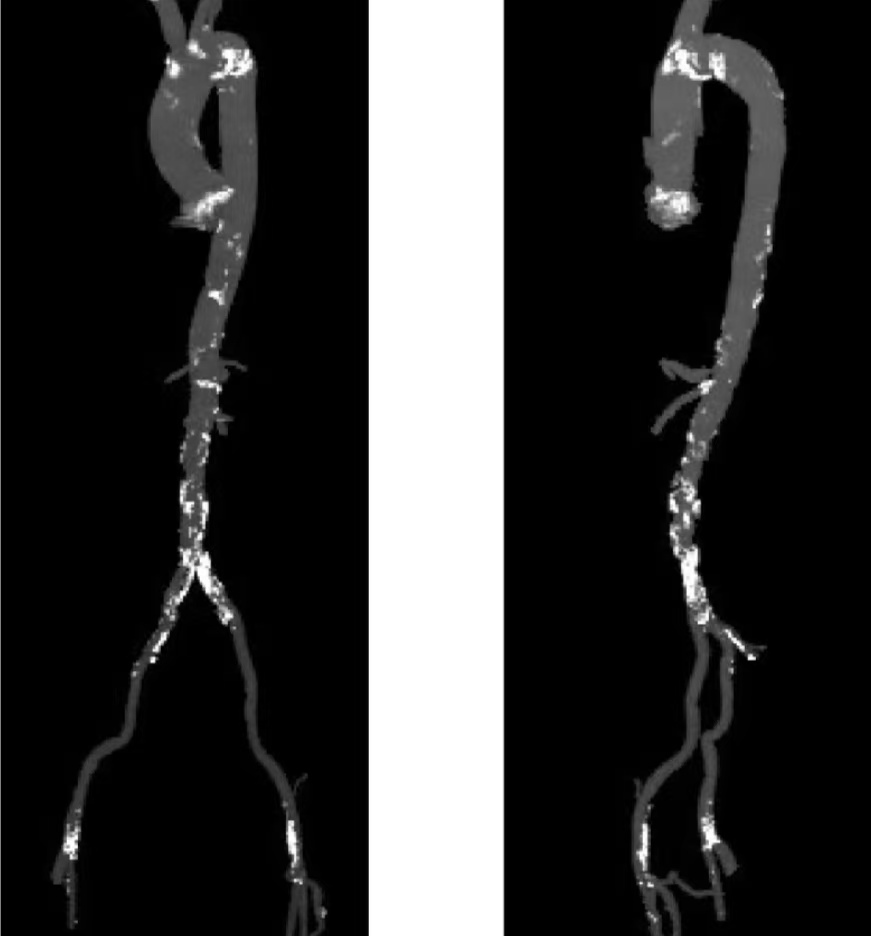 一次手术破解三重危机 湘南学院附属医院成功开展 “PCI+TAVR”一站式微创治疗
