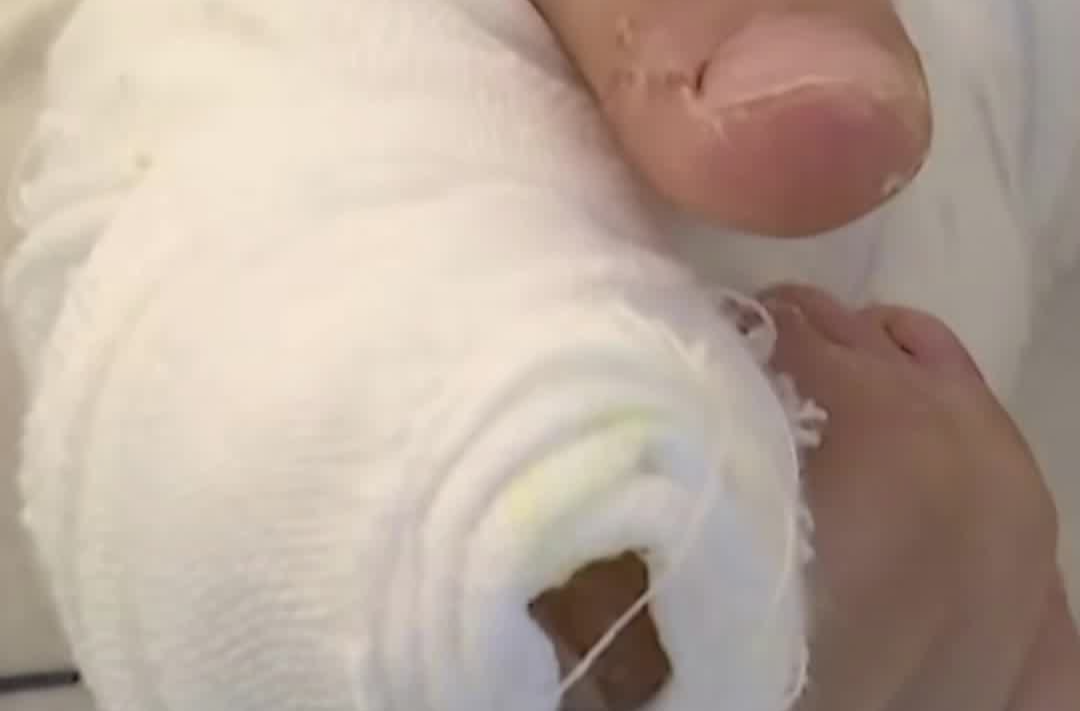 孩子爱咬指甲，手指严重感染紧急手术