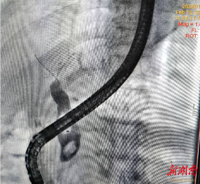 怀化市中心医院靖州院区成功为肝移植术后患者实施ERCP取石术