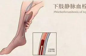 “静脉血栓栓塞症”正悄悄威胁这类人群 怎么办