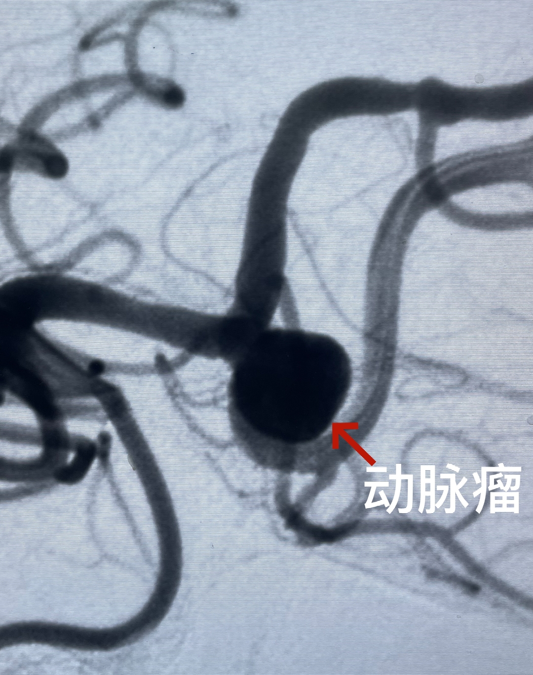 “小灯笼”照亮生命禁区，脑动脉瘤治疗添利器