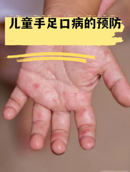 湖南省疾控端午假期育儿防疫提示：手足口病进入高发期，小贴士来啦