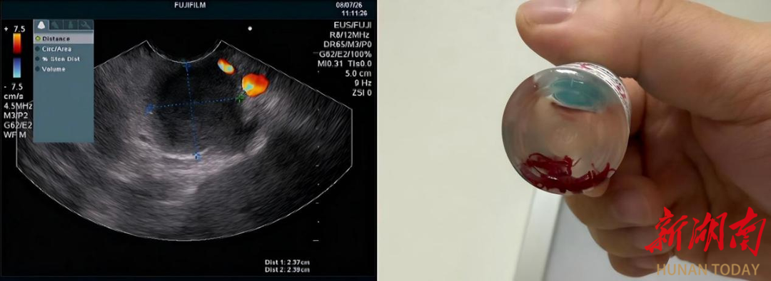 体检发现胰腺占位难辨良恶，南华医院超声内镜精准穿刺锁定“真凶”