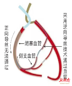 新鲜！衡阳市中心医院心血管内科支架手术倒着做