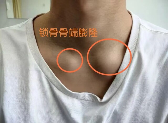 痘痘久治不愈,病根或许不在皮肤