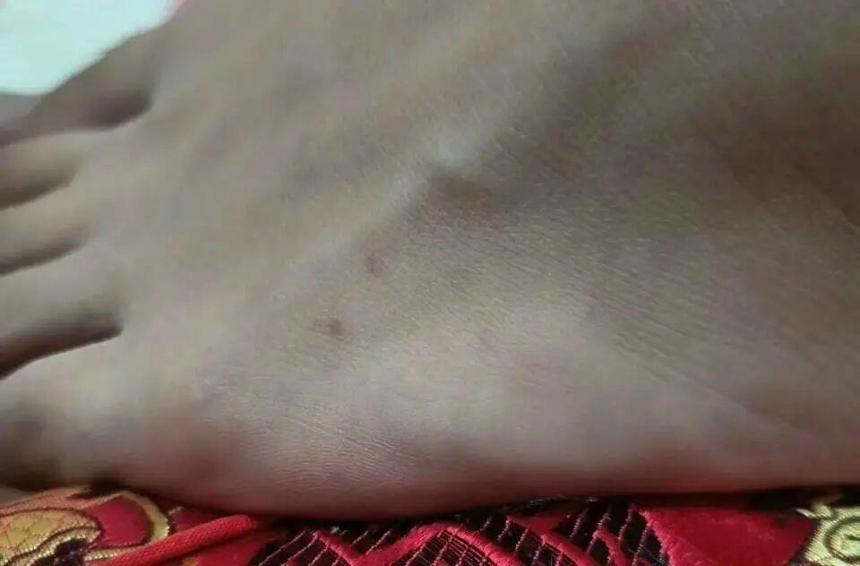 随口一句话,救了他一命!脚上的致命“小红点”险些被忽视