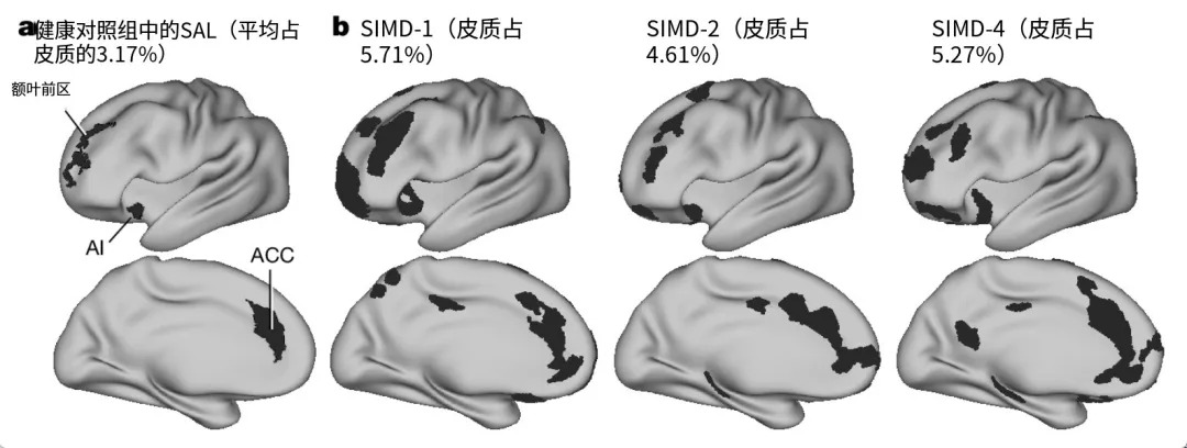 抑郁症病人的大脑,到底发生了什么?真相惊人