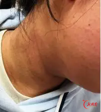 几乎每天一杯奶茶，17岁女生脖子越来越黑，怎么搓都洗不干净！医生：不是脏，是身体在报警