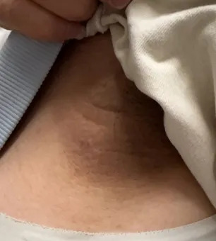 假日·提醒丨每天一杯奶茶,17岁孩子脖子越来越黑?医生提醒:这不是脏,是身体在报警