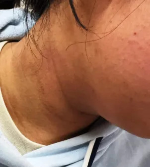 假日·提醒丨每天一杯奶茶,17岁孩子脖子越来越黑?医生提醒:这不是脏,是身体在报警