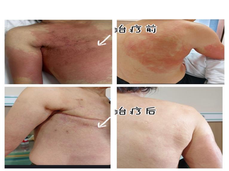 妙解丹毒!邵阳市中医医院乳腺科守护乳腺癌患者康复路