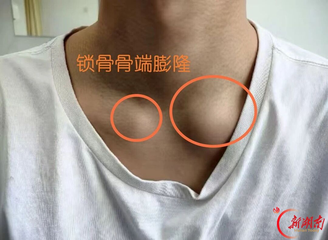 痘痘久治不愈,病根或许不在皮肤,警惕少见风湿免疫病SAPHO综合征!