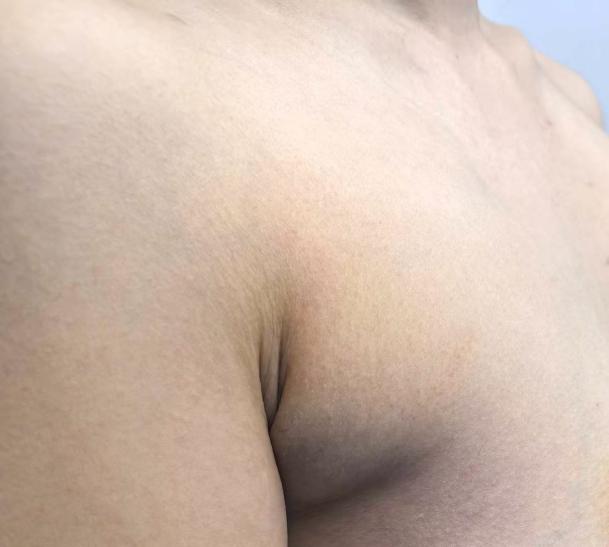 告别胸侧腋下臃肿显壮!联合塑形术找回自信
