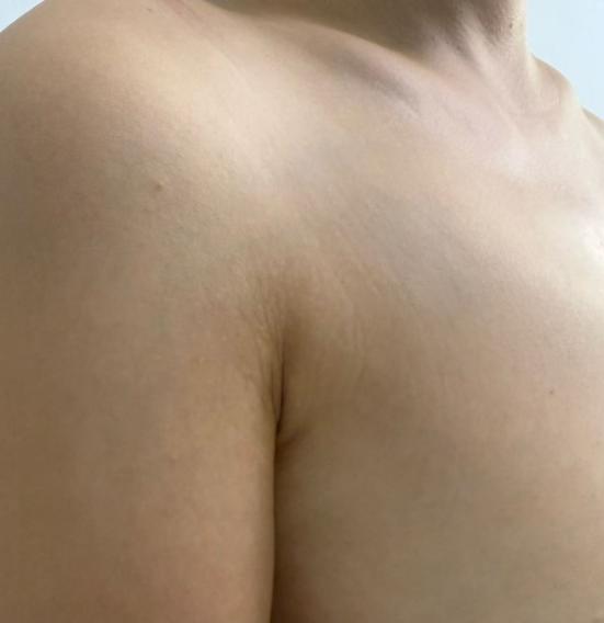 告别胸侧腋下臃肿显壮!联合塑形术找回自信