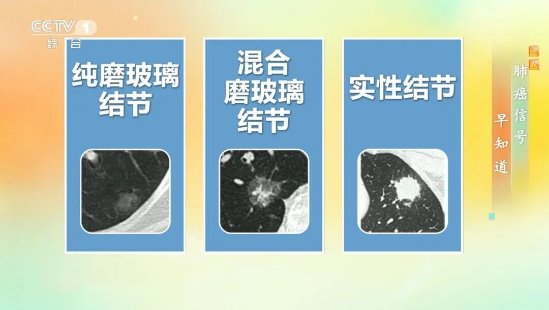 体检查出肺结节,会发展成肺癌吗?出现这些特征要警惕