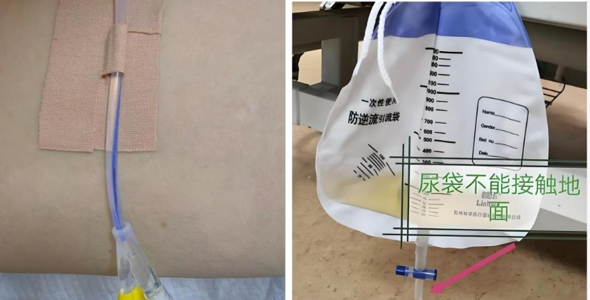 康复之路⑦|留置导尿管回家,该怎么护理?别慌,做好这几步就安心!
