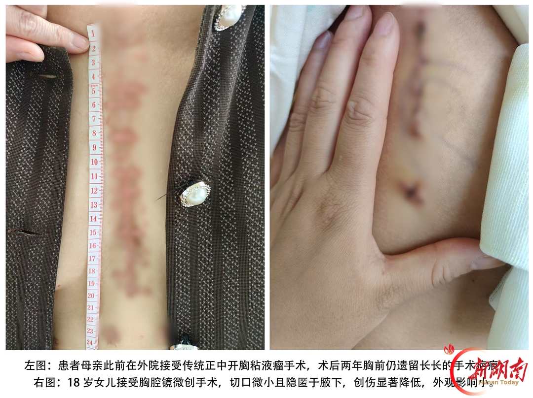 湘雅三医院心胸外科成功救治多例复杂心脏黏液瘤患者