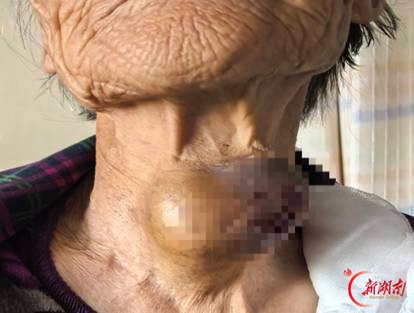轻信外敷草药,颈部肿块破溃!湘雅三医院为84岁老人摘除8cm巨大甲状腺肿瘤