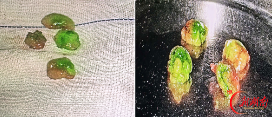 双示踪技术精准“导航”，南华医院乳甲外科助乳腺癌患者保腋窝除病灶