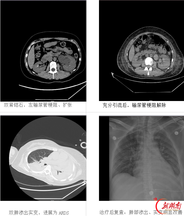 郴州市第四人民医院：多学科协作 成功救治尿源性脓毒血症危重患者