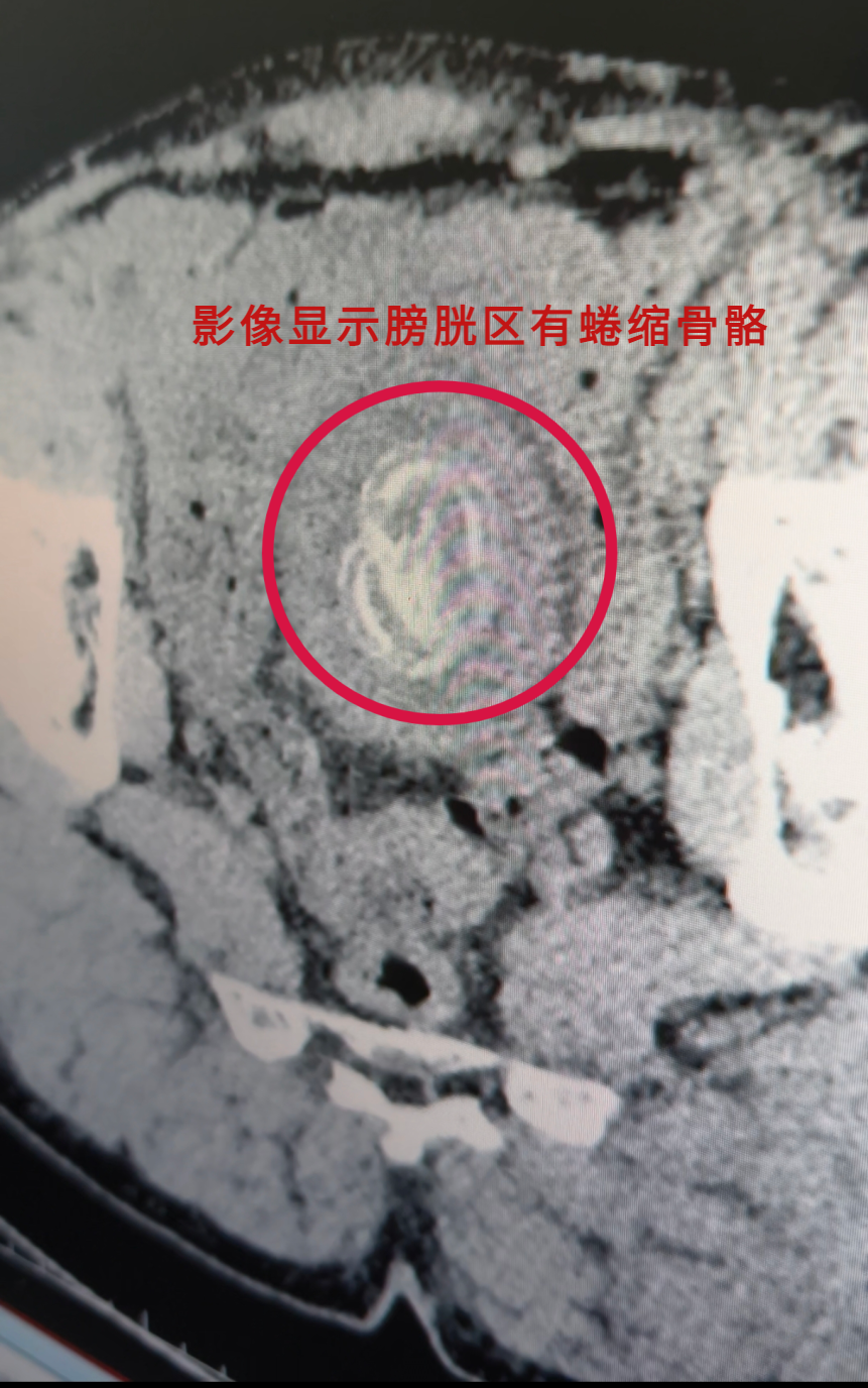 28厘米“异物”闯入膀胱 郴州市第三人民医院紧急救治 化险为夷