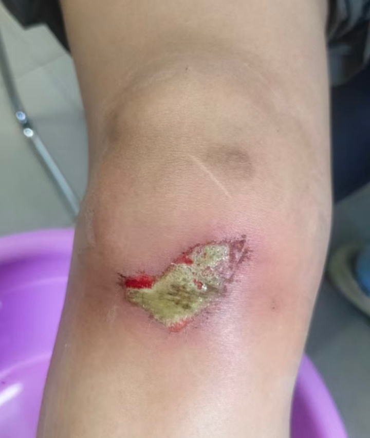 女子骑车摔破皮没在意，结果高烧近40℃进医院，差点成严重全身感染！医生紧急提醒！