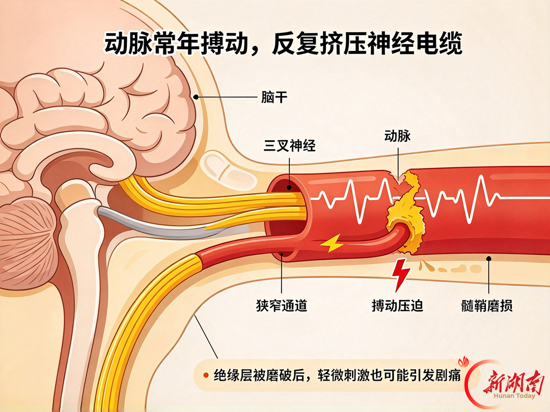 脸痛3年拔牙无效?这种“夺命痛”别再忍!